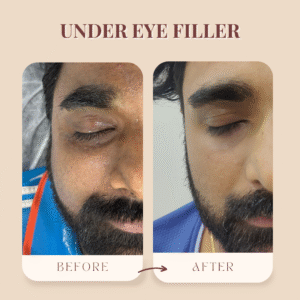 Under-Eye Wellness Solutions for Puffiness & Dark Circles