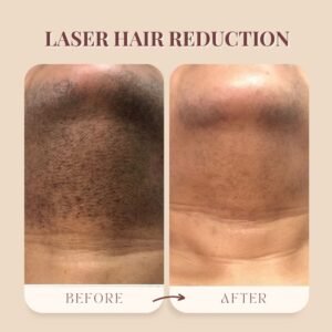 Laser hair reduction | Midas Wellness Hub