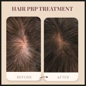Hair PRP Results| Midas Wellness Hub