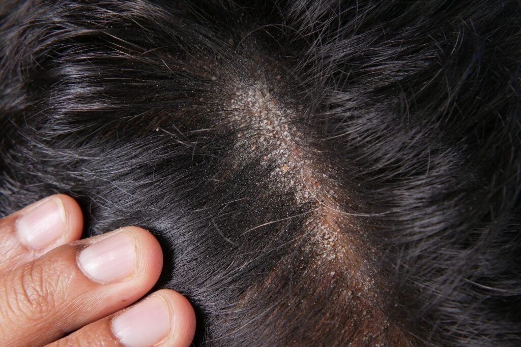 Best Clinical Dandruff Treatments That Work Faster Than Home Remedies