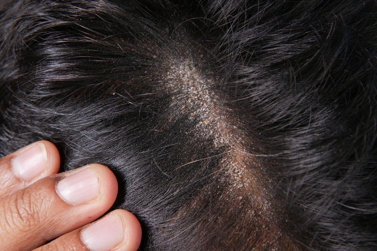 Best Clinical Dandruff Treatments That Work Faster Than Home Remedies