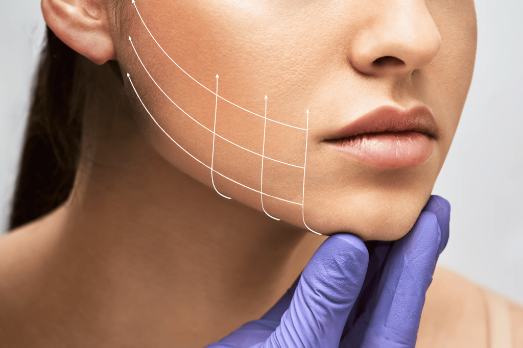 Thread Lifts Redefined: Painless, Personalized and Perfectly Natural for Everyone