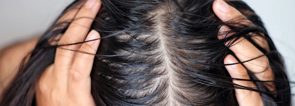 Scalp Health: How to Fix Dandruff, Itching, and Oily Scalp from Within