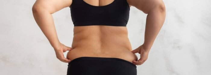 Why Cryolipolysis at Midas Wellness Hub Delivers Better and More Effective Results Than Other Clinics
