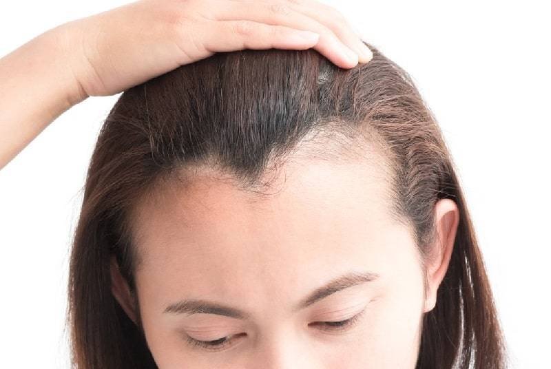 What Are the Causes for Temple Hair Loss & Its Treatments