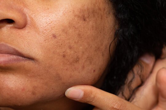 Pigmentation in Indian Skin: Causes, Types, and Effective Clinical Solutions