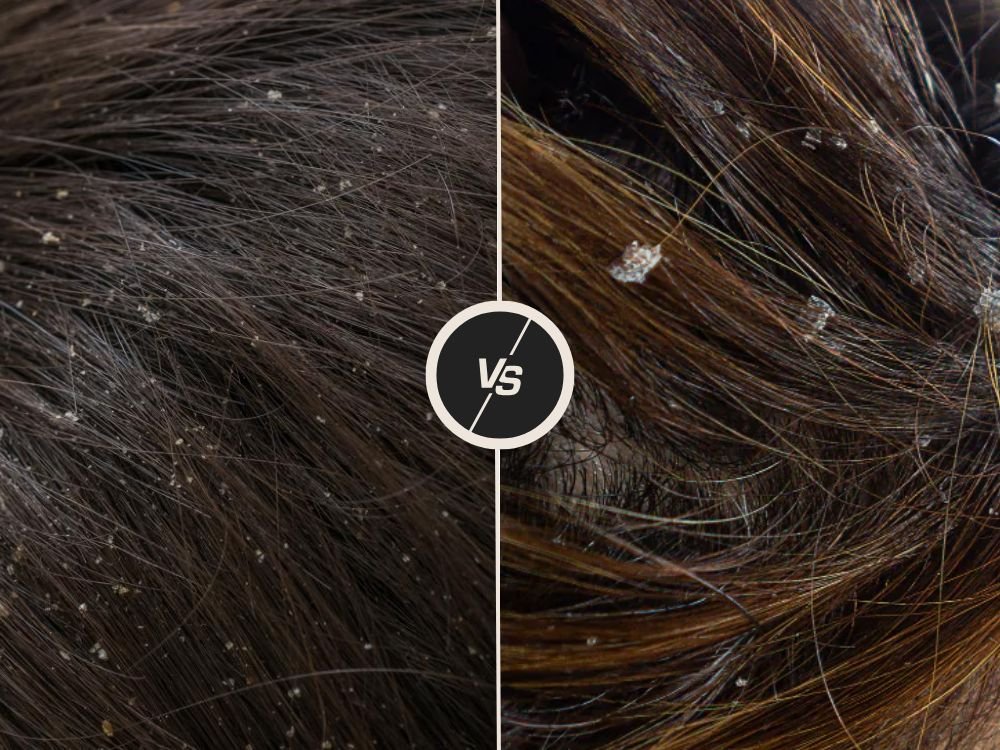 Dandruff and Scalp Care Solutions at Midas Wellness Hub.