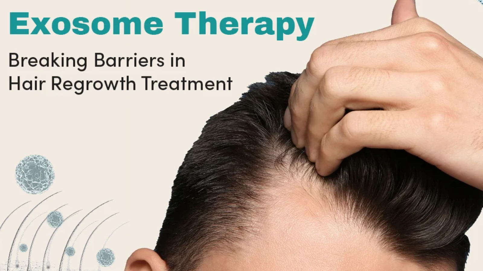 Exosome Therapy for Hair Loss: The Next Big Breakthrough After PRP