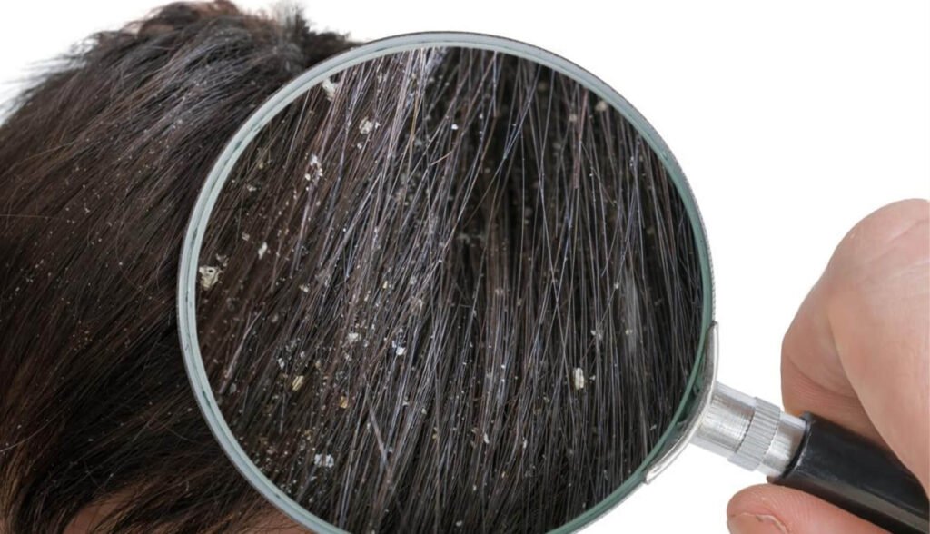 Best Dandruff Treatment for Itchy, Flaky & Inflamed Scalp