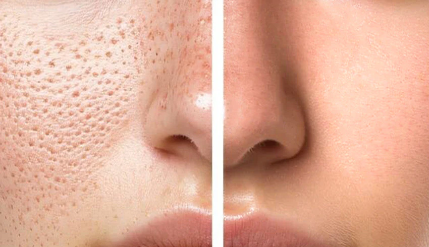 what really causes open pores? genetics, oil, ageing & lifestyle explained
