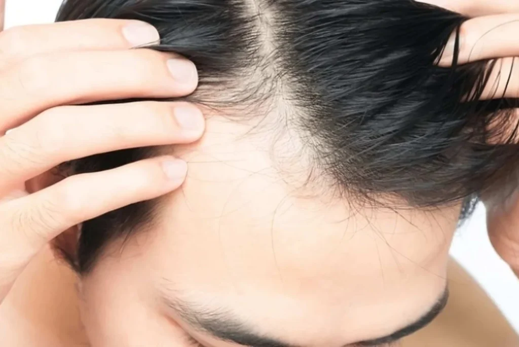 Receding Hairline Stages: Causes, Progression, and Expert Hair Loss Solutions at Midas Wellness Hub