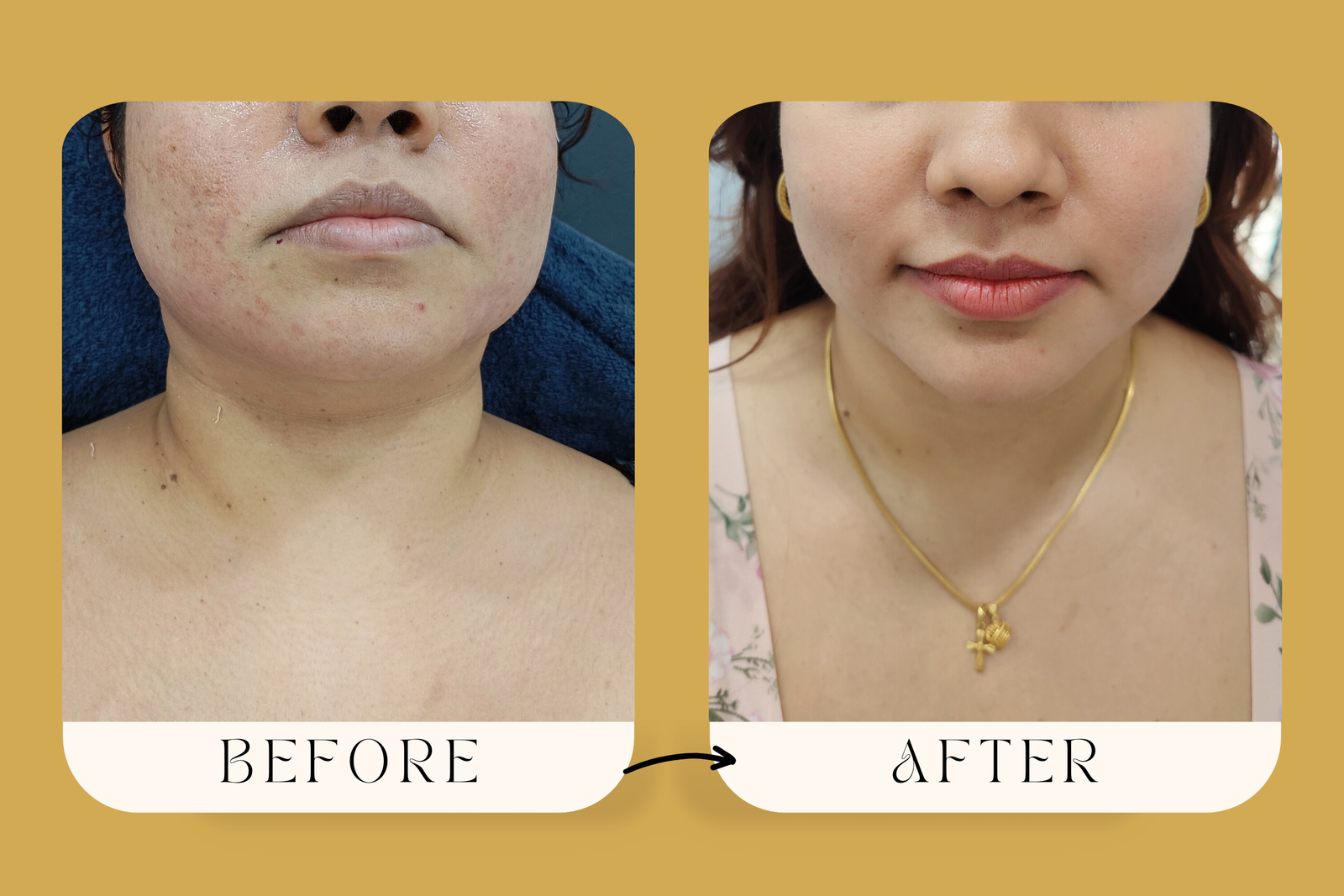 Non-Surgical Face Lift with Threads | Midas Wellness Hub