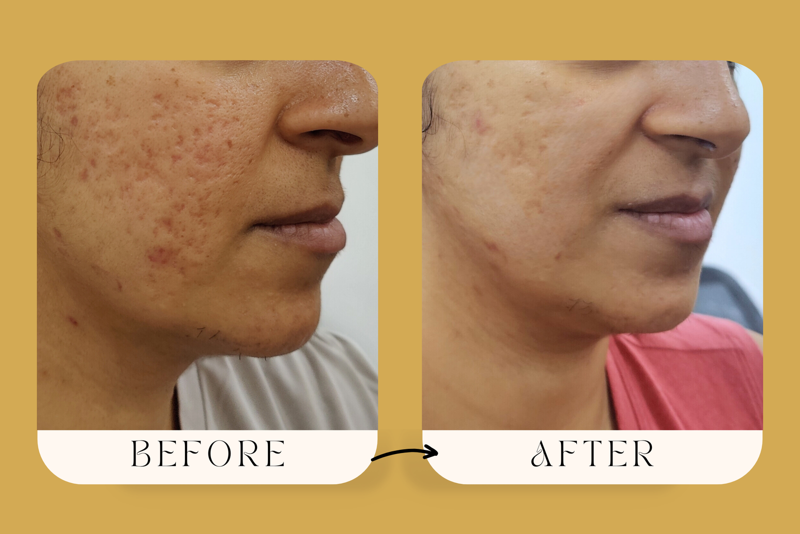 Scar Clear Skin Treatment | Best Clinic in Borivali