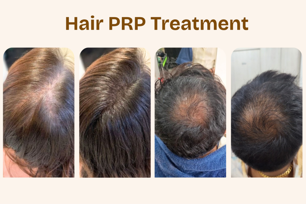 Before and after results of Hair PRP Treatment in Borivali showing improved hair density and reduced hair thinning at Midas Wellness Hub.