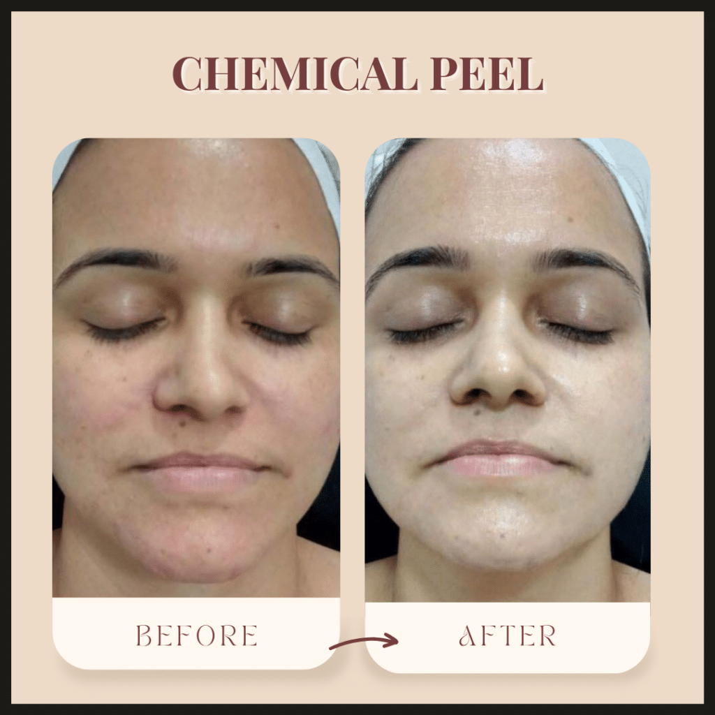 Before and after results of Chemical Peel Treatment in Borivali at Midas Wellness Hub