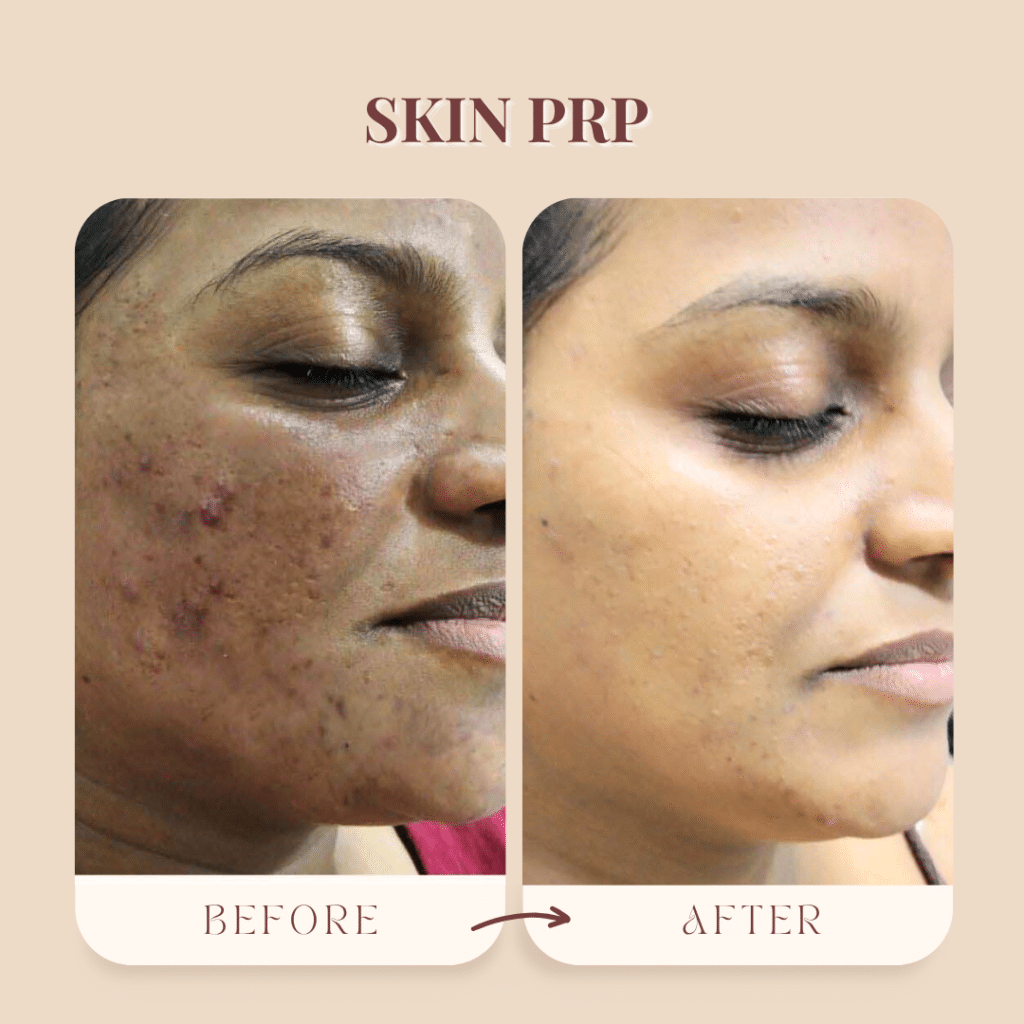 Skin PRP Treatment in Borivali before and after patient transformation