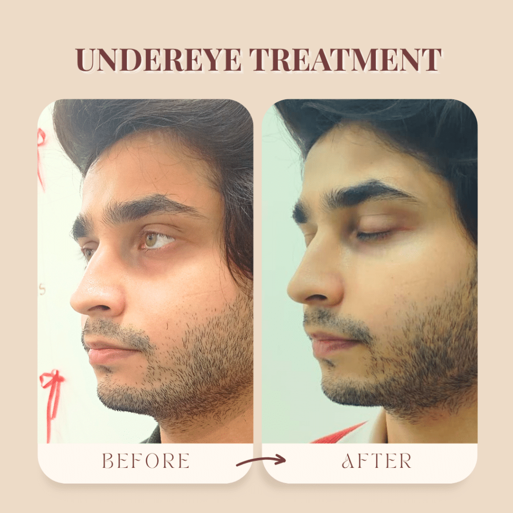 Before & after dark circle treatment in Borivali showing improvement in under-eye dark circles.