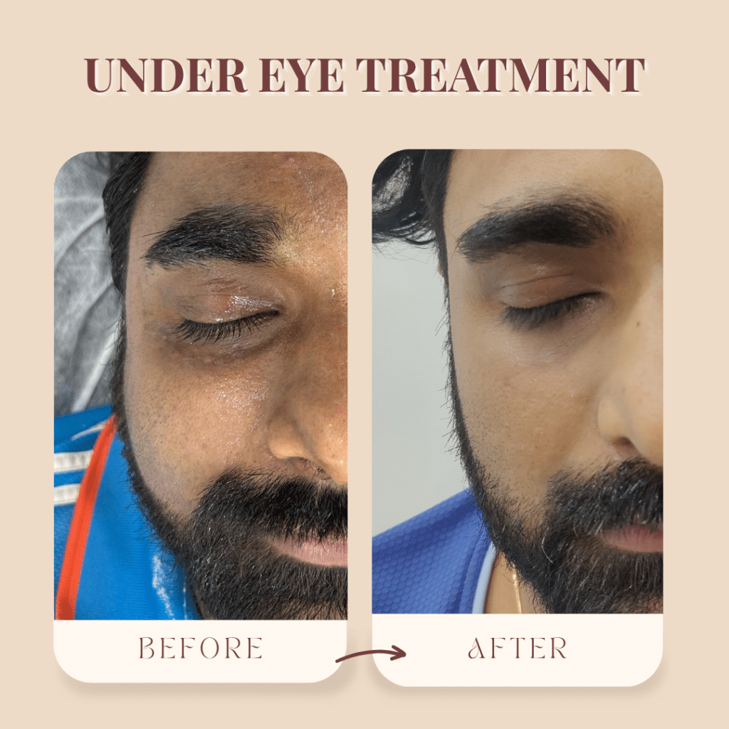 Dark circle treatment in Borivali before and after result showing brighter, more even-looking under-eye skin.