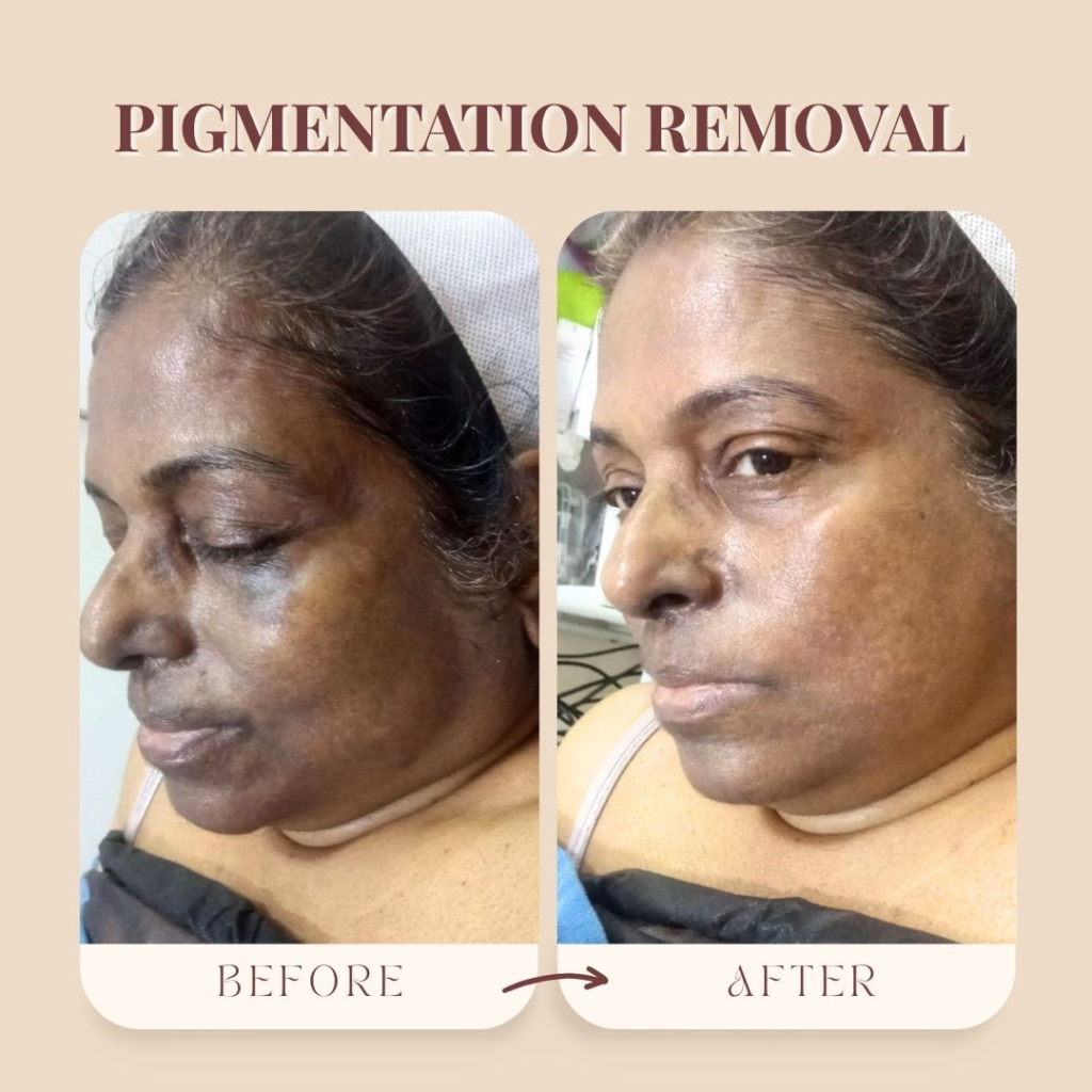 Hyperpigmentation before Pigmentation Removal Treatment in Borivali