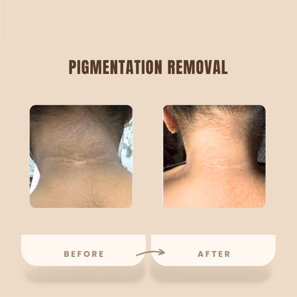 Advanced Pigmentation Removal Treatment in Borivali for dark spots and uneven skin tone